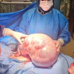 خارج‌ کردن توده ۱۰ کیلویی از شکم یک بیمار در کرج